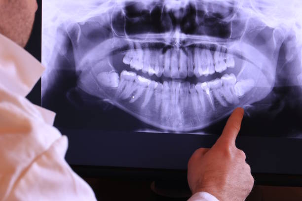 Emergency Dental Filling Replacement in WA